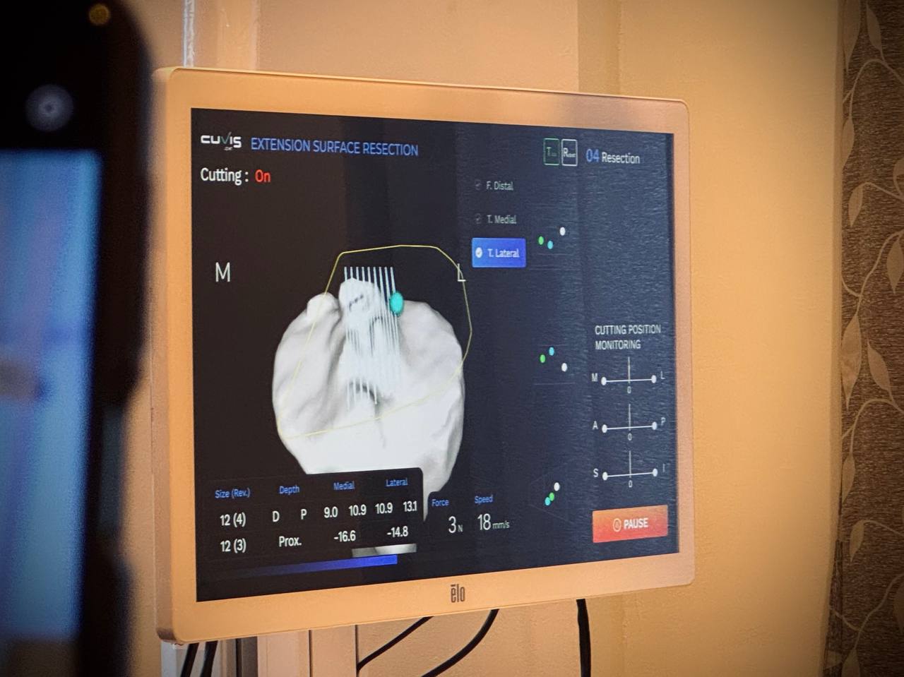 pembedahan penggantian sendi lutut melalui sistem robotik teknologi CUBIS Joint Hospital Pakar KPJ farid