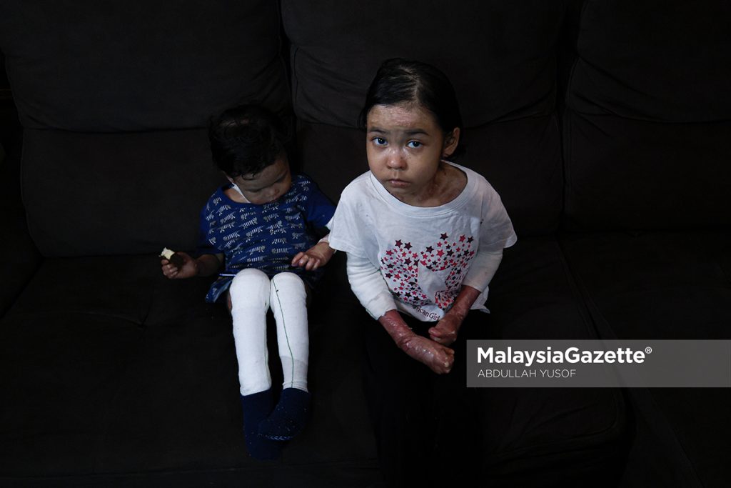 Suami isteri tabah urus dua anak kulit rapuh walau kos tinggi