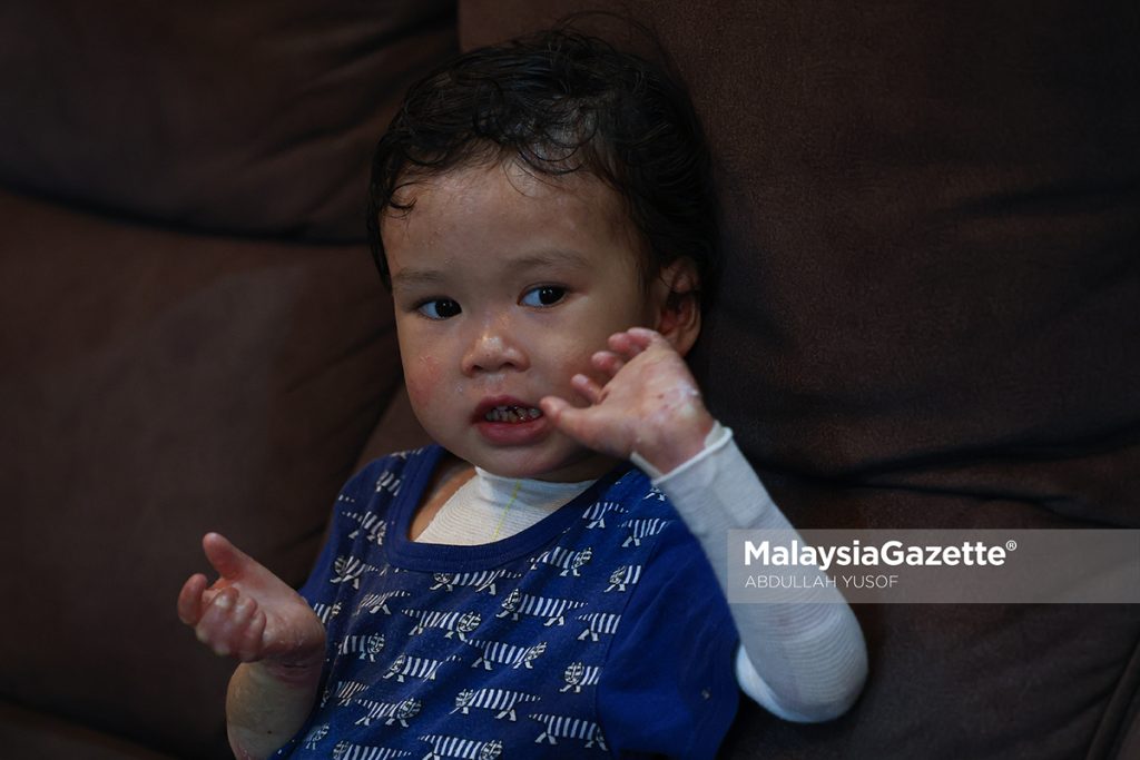 Suami isteri tabah urus dua anak kulit rapuh walau kos tinggi