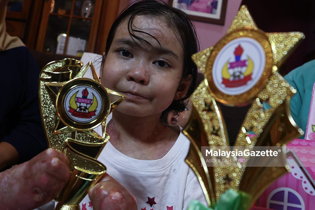 Suami isteri tabah urus dua anak kulit rapuh walau kos tinggi